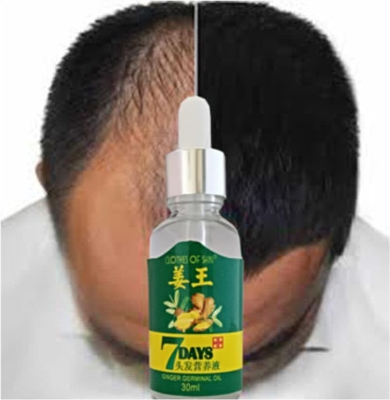 7days Ginger Germinal Essential Oil Hair Growth Loss Treatment Serum Uni 30ML