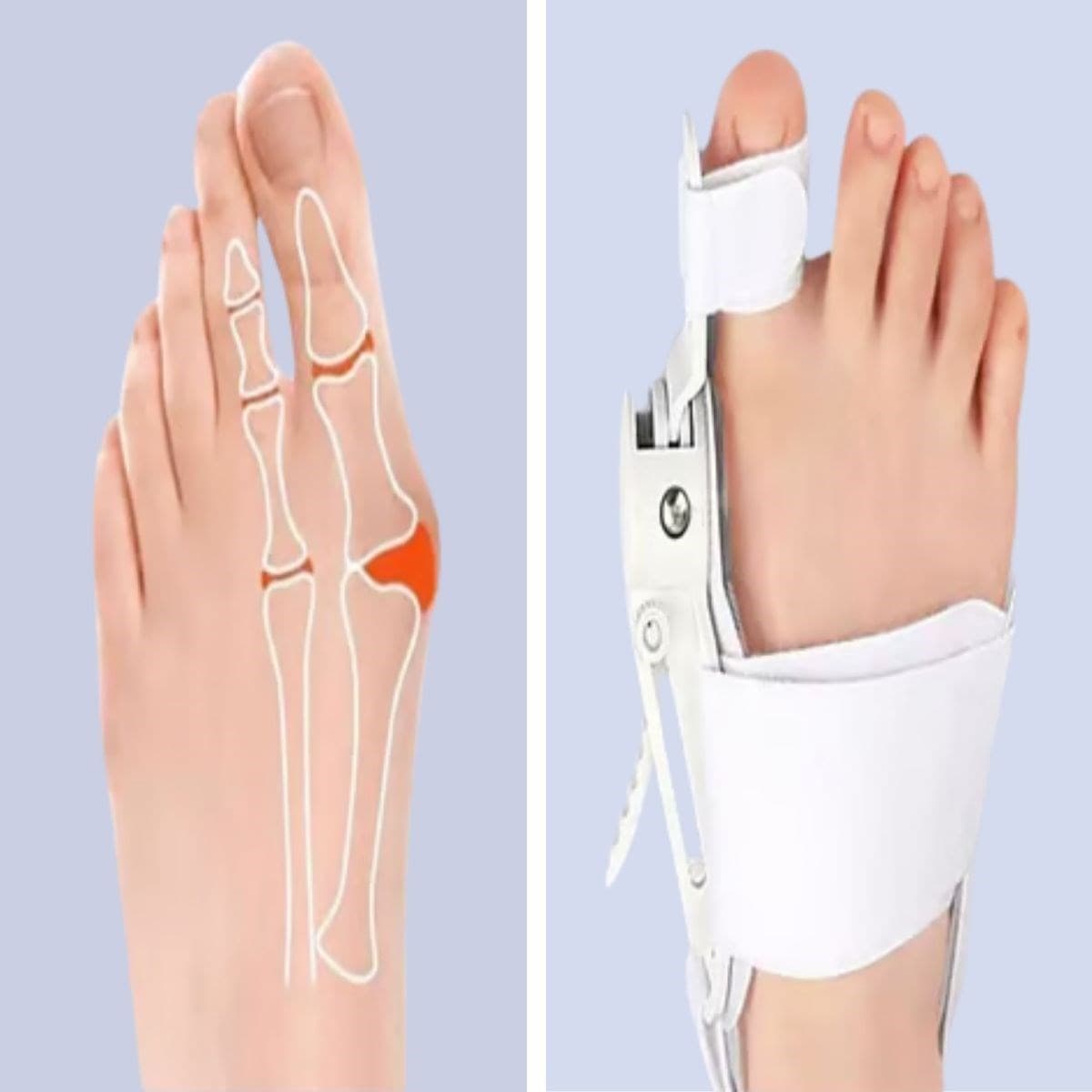 Ayarlanabilir Ayak Baş Parmak Kemik Düzeltici – Halluks Valgus